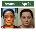 Traitement qui élimine définitivement l'eczéma, le psoriasis et les démangeaisons