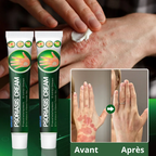 Traitement qui élimine définitivement l'eczéma, le psoriasis et les démangeaisons