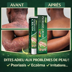 Traitement qui élimine définitivement l'eczéma, le psoriasis et les démangeaisons
