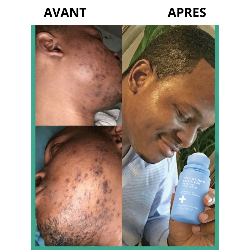 Sérum Hydratant anti Boutons & poils incarnés